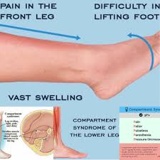 Image result for periostitis