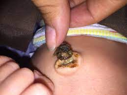Babies are fragile little things. Goop Under Umbilical Cord May 2018 Babies Forums What To Expect