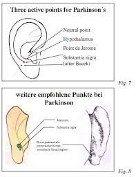 Acupuncture For Parkinson S Disease 290 Publications Parkinson Qigong