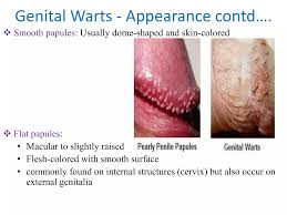 Image result for genital warts