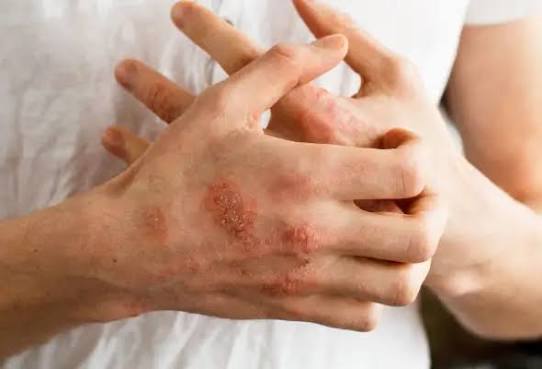 Psoriasis: Síntomas, causas, tratamiento y remedios caseros