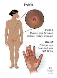 Image result for Tertiary Syphilis