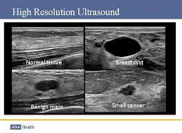 My doctor found a lump in my breast during my yearly mammogram and then brought in an ultrasound technician to follow up with an ultrasound for a closer look. Ucla Health On Twitter What Does Breastcancer On An Ultrasound Look Like Uclamdchat Http T Co Rayischnso Http T Co 9ptl6l0i6l