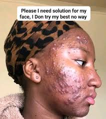 HOW TO MANAGE RASHES CAUSE BY FUNGI THAT ARE ITCHING SEVERELY I NEED HELP  PLAN FOR