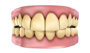 Image result for Tooth Discoloration