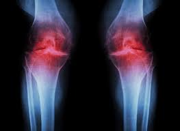 Image result for osteoarthritis