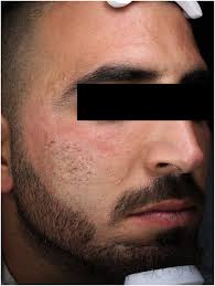 Energy‐based devices for the treatment of Acne Scars: 2022 International  consensus recommendations