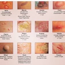 24 Comprehensive Rash Chart Pictures