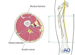 Upper thigh cross sectional anatomy. Safe Zones For Pin Placement