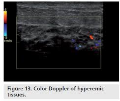 Color Doppler Sonography Characterizing Breast Lesions