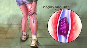 La trombosis venosa profunda y la embolia pulmonar (tvp y ep) son afecciones que no se diagnostican con frecuencia y son graves, pero se pueden prevenir. Trombosis Venosa Profunda Cardiocare