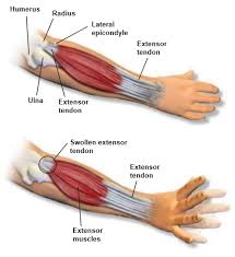 It is sometimes called tennis elbow, although it can occur with many activities. Lateral Epicondylitis Central Coast Orthopedic Medical Group