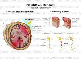 Image result for Diffuse Axonal Injury