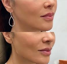 Shari Ortiz — Botox, Filler, Fat Removal │ Aluma Medical Aesthetics