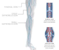 Venous Reflux Disease Virginia Cardiovascular Specialists
