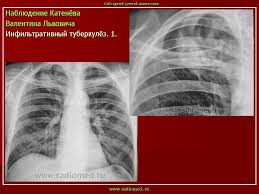 Tuberkulyoz Infiltrativnyj Tuberkulyoz Portal Radiologov
