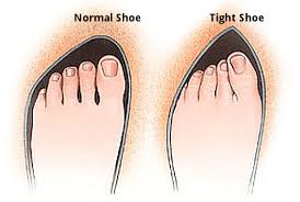 Image result for BUNIONS in shoes