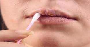 Los 7 Mejores Remedios Caseros Para Fuegos En La Boca Natural Cold Sore Remedy Cold Home Remedies Cold Sore