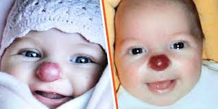 Girl Born with Red Nose Was Cruelly Called 'Rudolph' for It