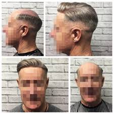 We serve men from all over downtown minneapolis and the st. Hair Systems Manchester Specialist Non Surgical Hair Replacement
