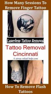 Since i am getting it removed the toxins are circulating through my body. Pin On Eliminacion De Tatuajes