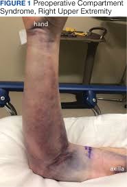 Image result for Compartment Syndrome