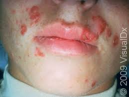 Image result for yellow scabs on the face in children