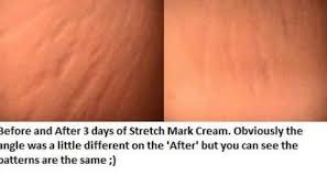 Bio Oil Stretch Marks Before And After Got The Mama Warrior Marks The Stretch Mark Cream Can Help With That I Am Currently Using That As Bio Oil Skin Bio Oil Stretch Marks Bio Oil Uses