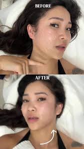 I didn’t expect this kind of lift after one treatment. Thank you  @polarisaestheticsla. Definitely will come back 🥰