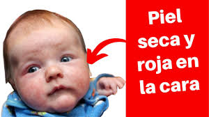 5 Causas Piel Roja Y Reseca En La Cara De Tu Bebe Youtube