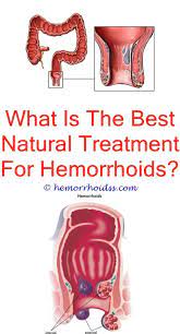 Should You Push External Hemorrhoids Back In Hemorrhoids Treatment Cure For Hemorrhoids Bleeding Hemorrhoids