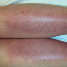 Here's everything you need to know about the effects of the sun on darker skin. Sunburn Purpura Mdedge Dermatology