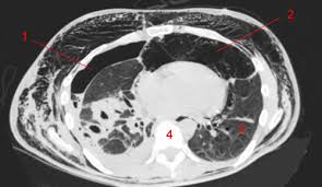 Petit hématome au point d'injection : Emphyseme Sous Cutane Scanner