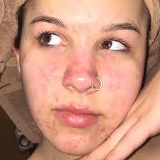 Emuaid.com has been visited by 100k+ users in the past month This Woman Treated Acne With 3 Products And The Before And After Pics Are Insane