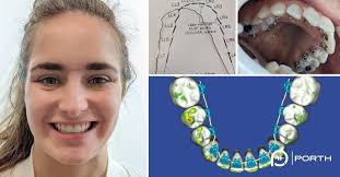 Hunching forward will cause your pelvis to move forward into the other than a traditional massage for chronic lower back pain, i've found a new way to get the knots and muscle stiffness out of my back. The Ultimate Guide To Lingual Braces Modern Orthodontic Clinic In Sammamish Bellevue