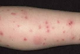 Image result for flea bites