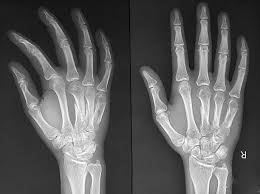 Fracture Ulnar And Radius Forearm Bone ...