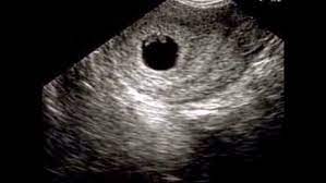 متى يظهر الجنين في كيس الحمل في اي اسبوع عالم حواء