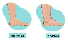 Image result for Edema Exam
