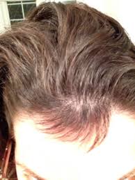 It takes anywhere from 4 to 13 weeks for the hair to grow from the dermal papilla (the base of the hair follicle) to the surface of the skin. Hair Loss Stopped Pic Growing Back October 2013 Babies Forums What To Expect