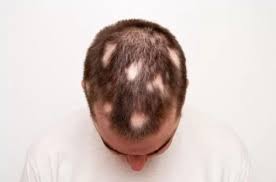 Di bawah kulit kepala, terdapat sel atau jaringan hidup yang disebut folikel. Mengenal Penyakit Alopecia Dan Cara Mengatasinya