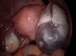 Clinical Review Abdominal Pain In Pregnancy Gponline