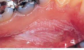More than 90 percent of cancers that occur in the oral cavity are squamous cell carcinomas. Mouth Cancer Diagnosis And Treatment Mayo Clinic