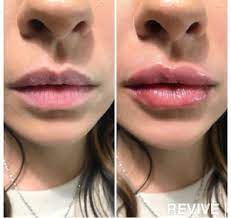 Lip injections can be for hydration, volume or both. Lip Filler Facts Revive Medical Philadelphia