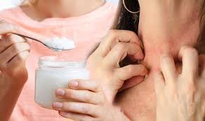 Eczema Coconut Oil S Benefits In Aiding Symptoms Of Eczema Express Co Uk