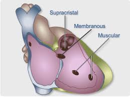 Image result for Ventricular Septal Defect