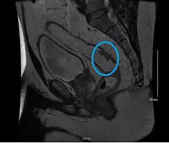 Preparation before test lab ct scan procedures. Management Of The Malignant Colorectal Polyp Is Formal Resection Needed Department Of Surgery
