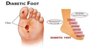 Check spelling or type a new query. Diabetic Foot Exams Council Bluffs Foot Ankle Care Pc Council Bluffs Ia Podiatrist