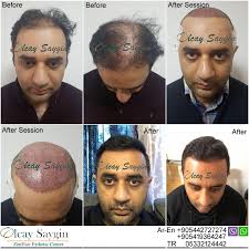 Best Hair Transplant Doctor In Turkey Hair Transplant Hair Transplant Results Hair Transplant Cost