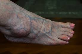 Having bulging veins on your biceps or shoulders makes the muscles stand out that little bit more and many people strive for the look it gives them. What Are Bulging Veins Causes Treatments The Vein Institute